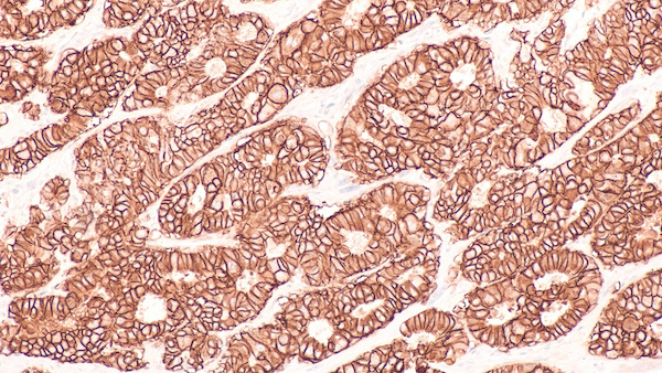Photomicrograph of immunohistochemistry for HER2,  showing positive cell membrane staining in this infiltrating ductal carcinoma.   Candidate for Herceptin.